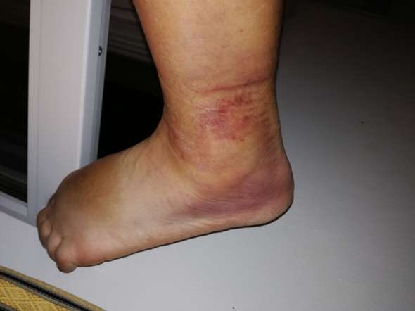 Fussgelenk Verstaucht 3 Gesundheit Und Medizin Schmerzen Fusse