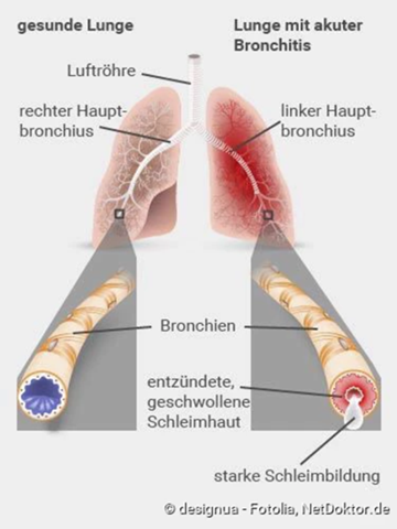 KANN MAN bei bronchytis alkohol trinken? (Gesundheit und Medizin ...