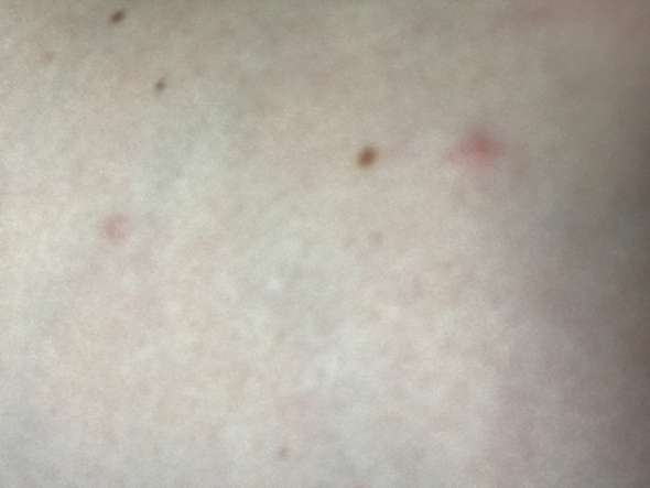Was Sind Das Fur Stiche Bzw Bisse Jucken