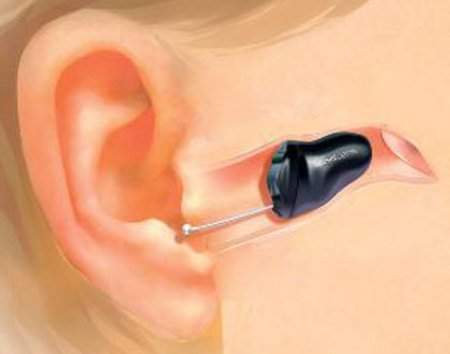  - (Gesundheit und Medizin, Ohr, Implantat)