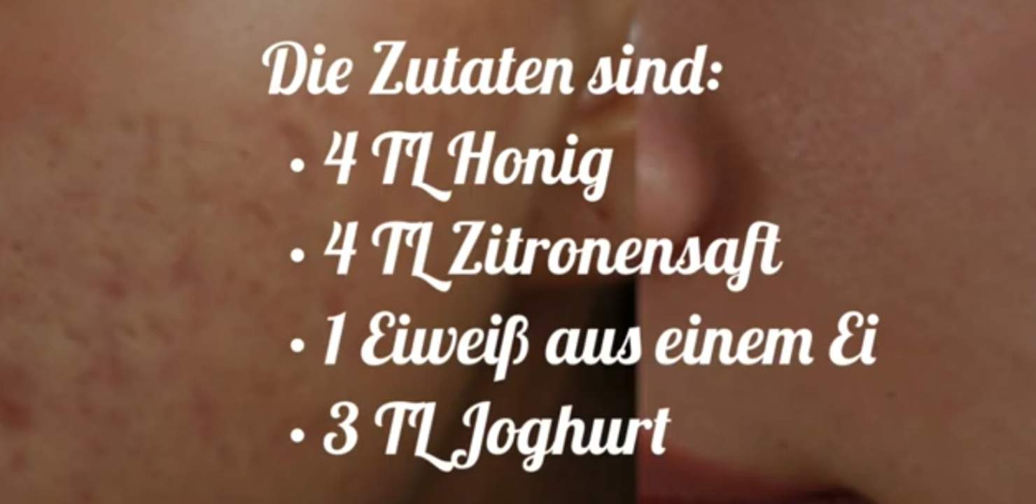 Was hilft alles gegen Ritznarben? (Gesundheit und Medizin, Ritzen, Narben)