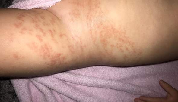 Ausschlag Beim Kleinkind Juckt Nicht Was Kann Das Sein Gesundheit Und Medizin Kinder