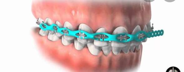 Zahnspange, gummis für Lücken? (Gesundheit und Medizin, Zahnlücke)