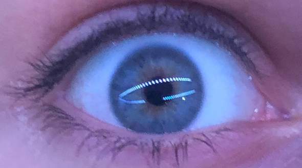 Blauer Ring Um Die Augen Ist Das Normal Gesundheit Blauer Ring Um Die Augen Ist Das Normal Gesundheit