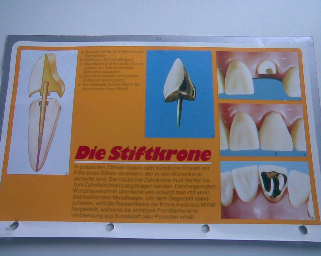 Wurzelbehandelter Zahn hat sich verfärbt, was tun? (Gesundheit und Medizin, Zähne)