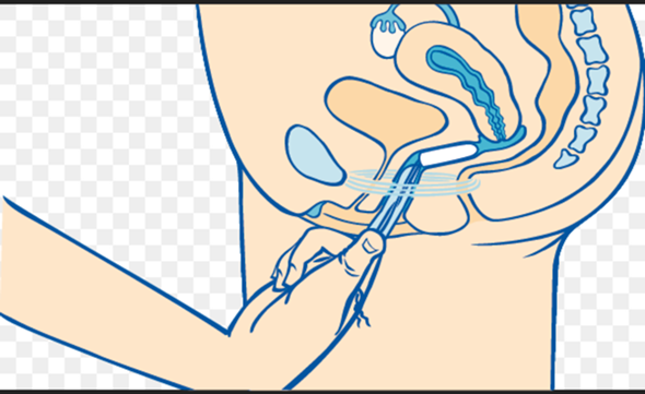 Nicht bekomme rein tampon den Hallo!! Ich