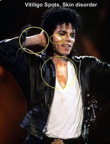  - (Michael Jackson, Hautfarbe, Hautkrankheit)