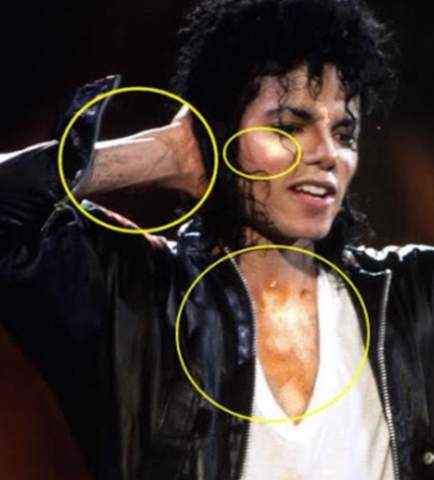  - (Krankheit, Haut, Michael Jackson)