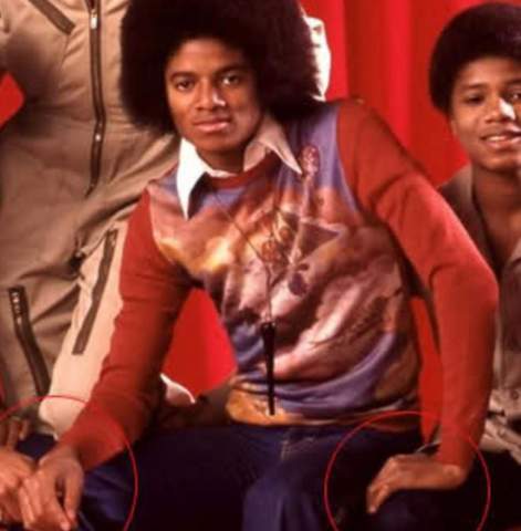  - (Krankheit, Haut, Michael Jackson)