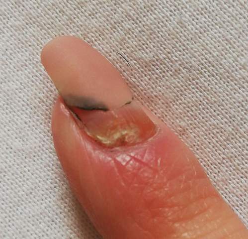 fingernagel entzundet rot gefarbt hand fingernagel nagelstudio