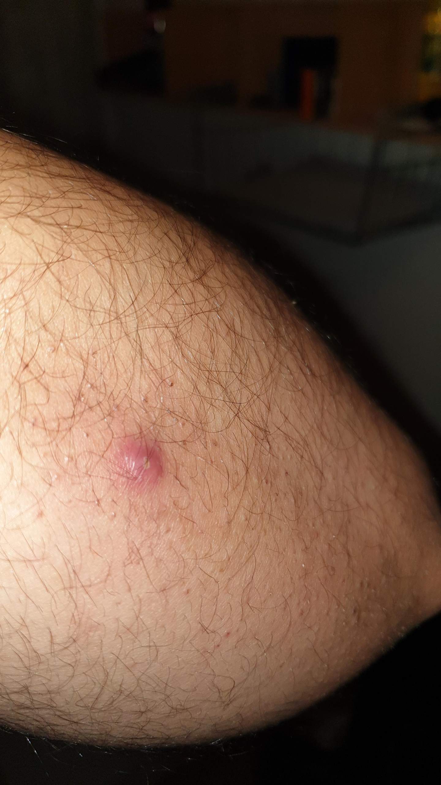 Sollte man eine ,,kleinere,, Entzündung am Arm oder so aufstechen oder