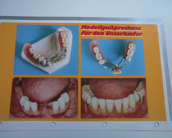 Löst sich nicht zahnprothese Probleme mit