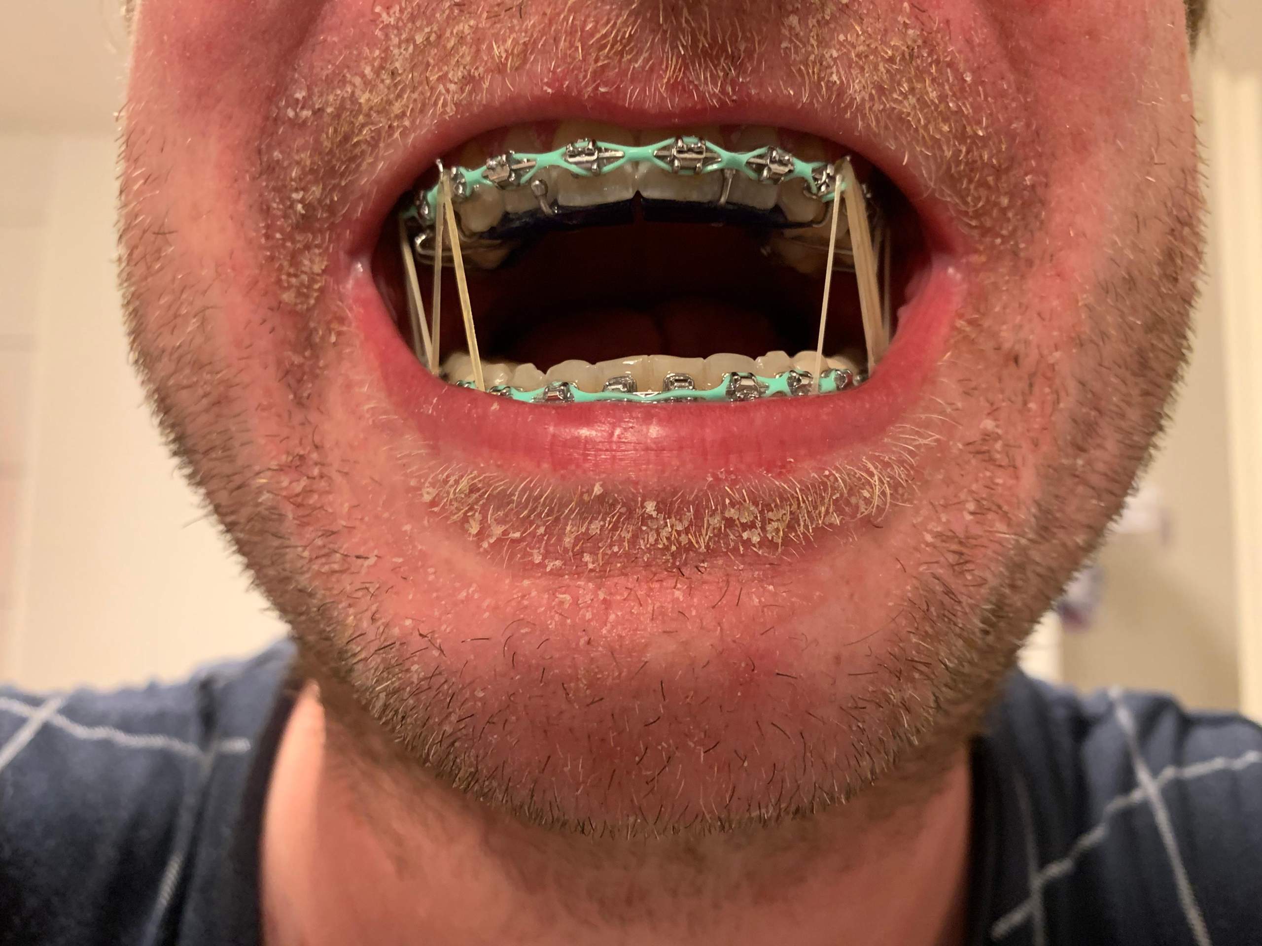 Feste Zahnspange Power Chain? (Kieferorthopäde)