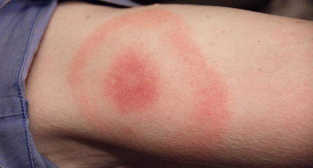 Zeckenbiss? (Gesundheit und Medizin, Juckreiz, Rötung) Zeckenbiss? (Gesundheit und Medizin, Juckreiz, Rötung)