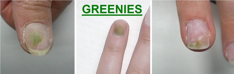 Grüner Nagel unter gelnägeln? (Gesundheit und Medizin, Gelnägel, Nagelpilz)