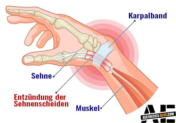 Handgelenk gips lange sehnenscheide entzündet wie Was tun