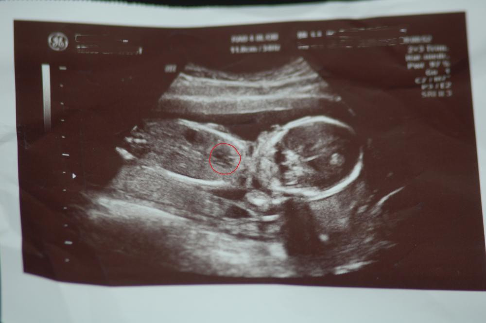 Baby Stirbt Im Bauch Anzeichen