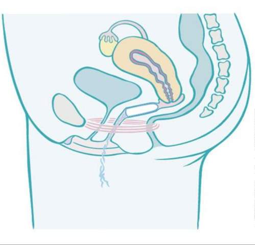 Den tampon rein bekomme nicht komme nicht