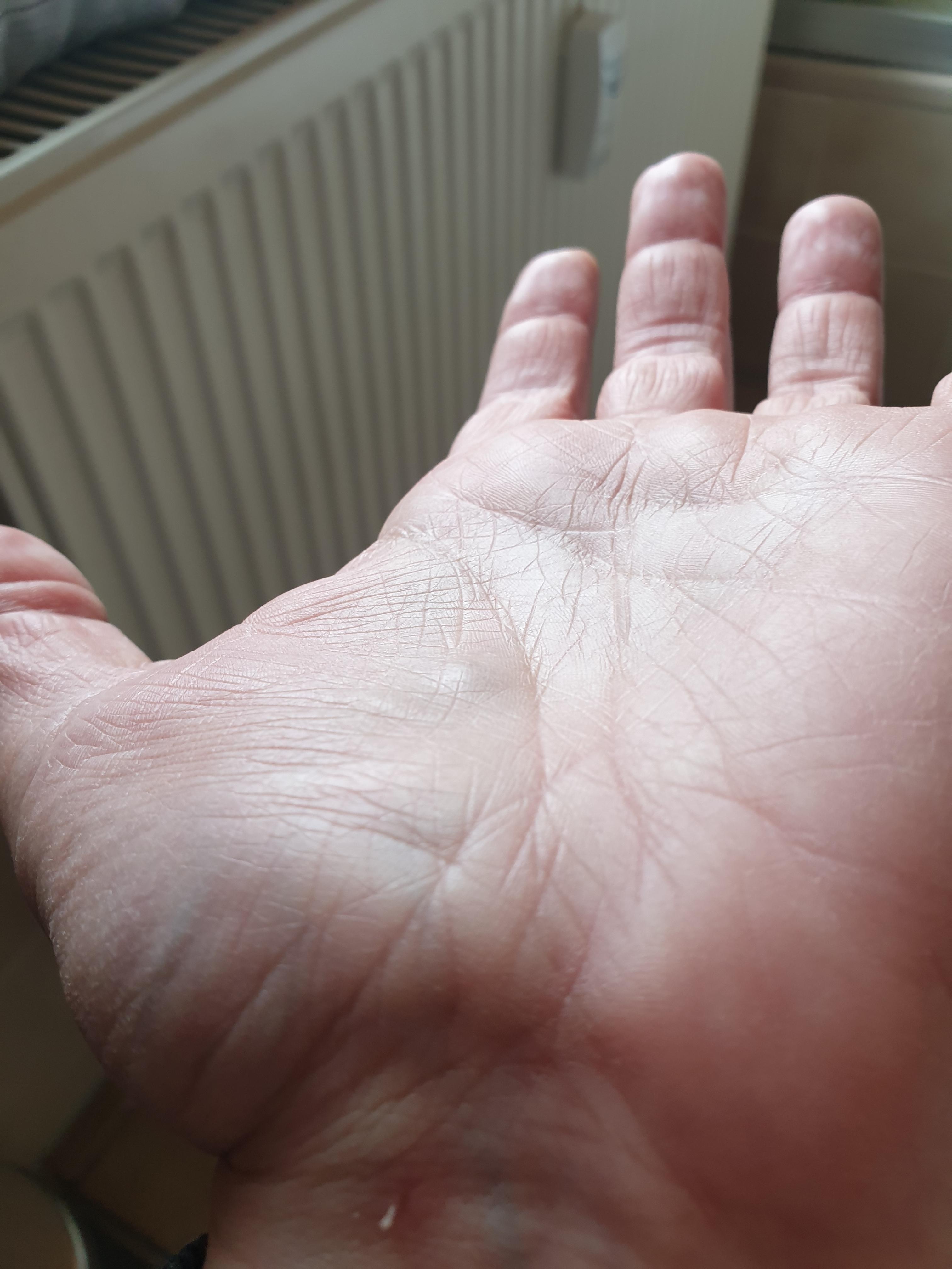 Handinnenfläche Knubbel normal? (Gesundheit, Medizin) Handinnenfläche Knubbel normal? (Gesundheit, Medizin)