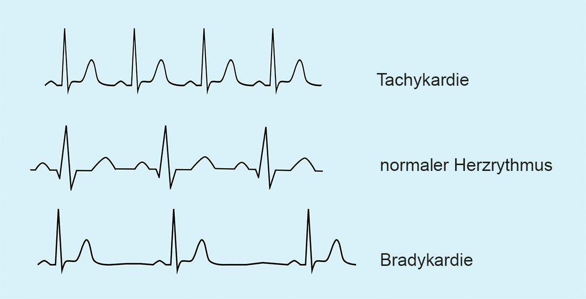 Was ist das im EKG? (Gesundheit und Medizin)