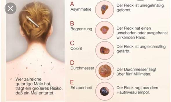 - (Gesundheit und Medizin, Muttermal)