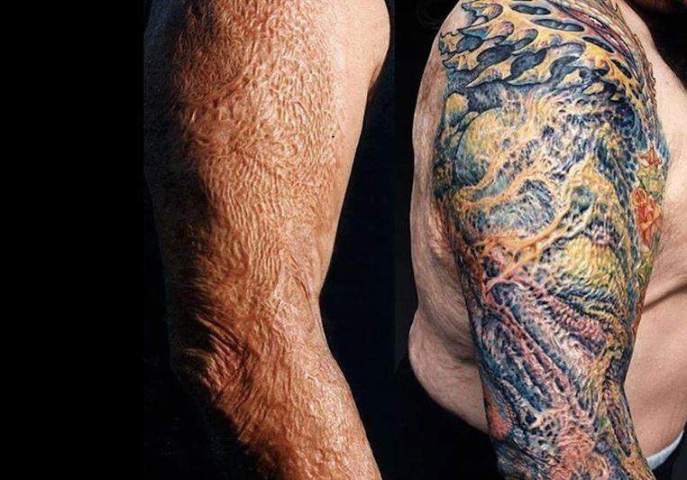 Kann man auf Narben tätowieren? (Gesundheit und Medizin, Psychologie, Tattoo)