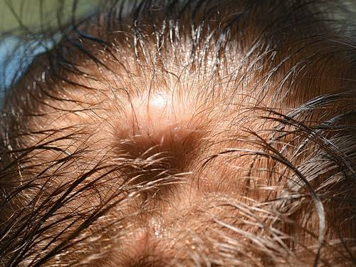 Zyste am Kopf entfernen lassen. Wie waren eure Erfahrungen? (Gesundheit ...