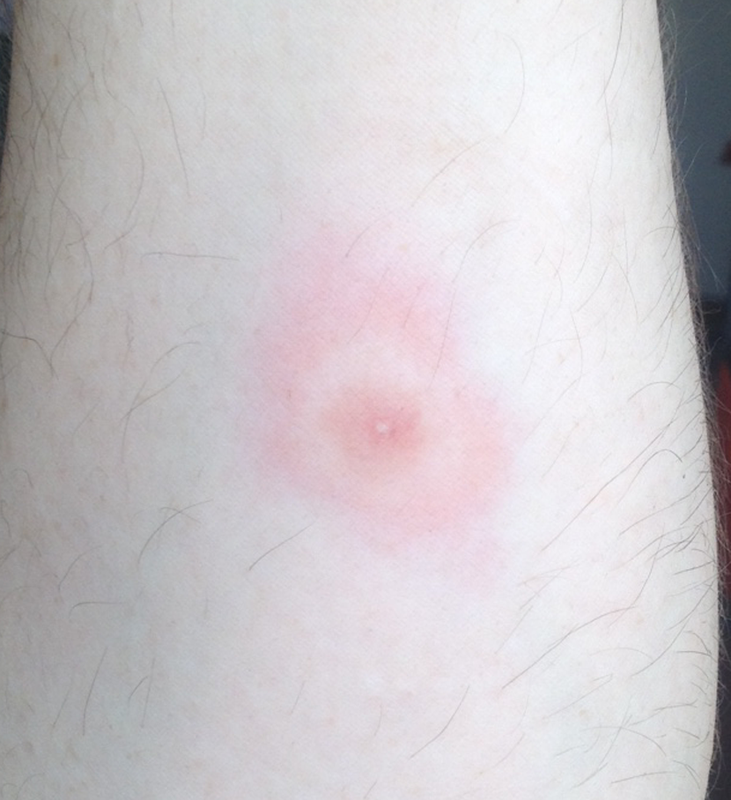 Wie Sieht Ein Verkapselter Insektenstich Aus Insektenstich? (Gesundheit und Medizin)