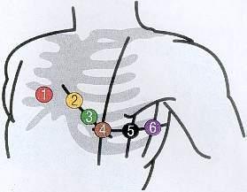 EKG Elektroden 12 Kanal Anlegepunkte - (Medizin, Untersuchung)