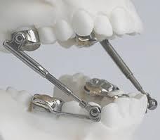 Metallscharniere - (Medizin, Zähne, Zahnspange)