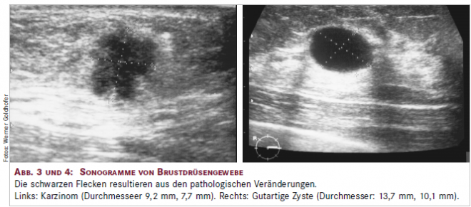 Wie Lange Bleibt Eine Zyste In Der Brust www.gutefrage.net