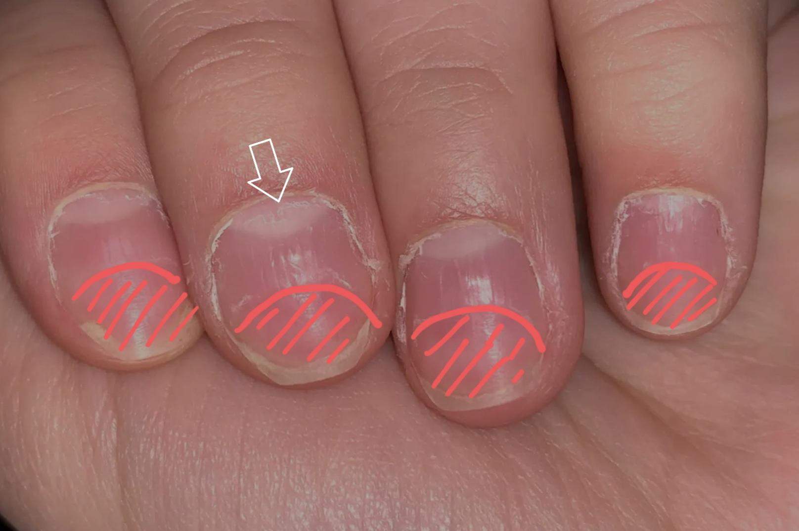 Fingernägel kaputt oder Nagelhaut? (Gesundheit und Medizin, Beauty, Nägel)