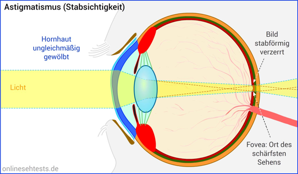 Hornhautverkrümmung mit mehr Dioptrin ausgleichen? (Augen, Dioptrienwerte)