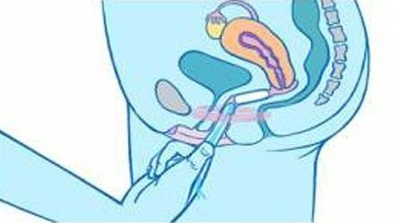 Tampon Sitzt Richtig Aber Schmerzt Schmerzen Tampon Sitzt Richtig Aber Schmerzt Schmerzen