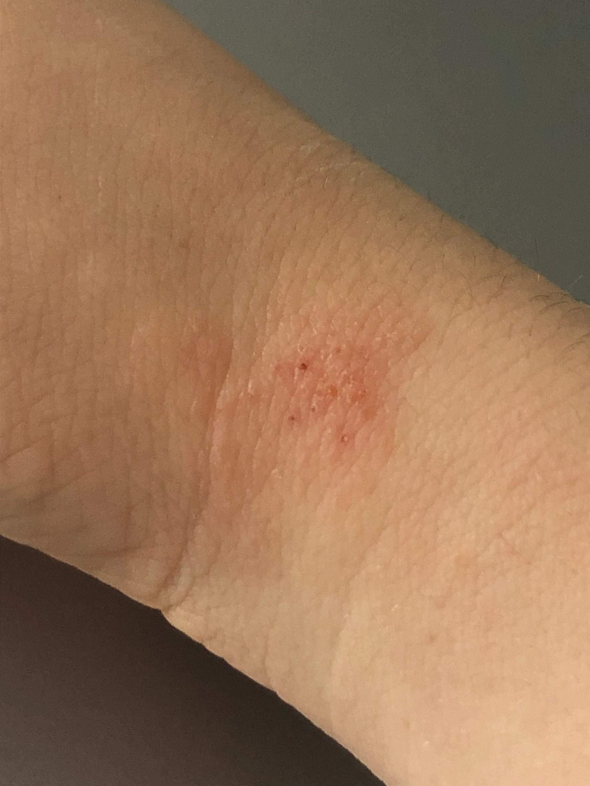 Insektenstich? (Insekten, Juckreiz, Hautausschlag)