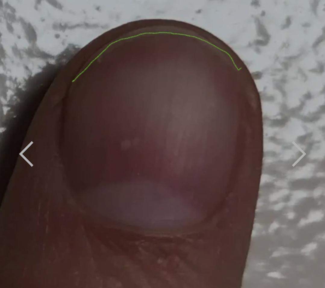 Braune Striche auf den Nägeln, löst sich vom Nagelbett? (Beauty, Aussehen, Schönheit)