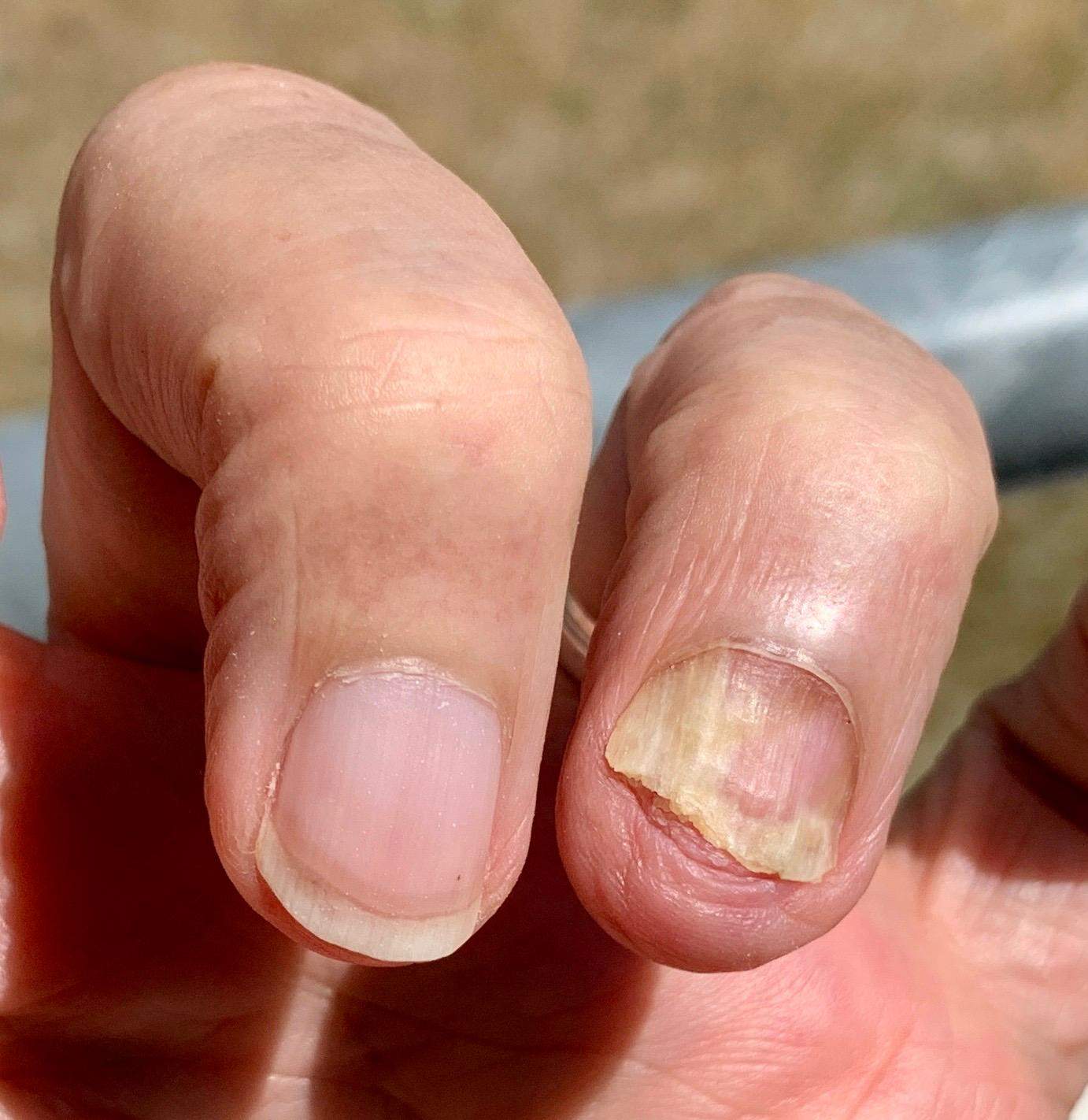 Fingernagel Pilz Was Kann Es Sein Gesundheit K rper Medizin fingernagel-pilz-was-kann-es-sein-gesundheit-k-rper-medizin