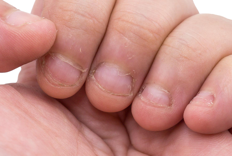 Nagel löst sich ab was tun? (Nägel, Finger, Fingernägel)