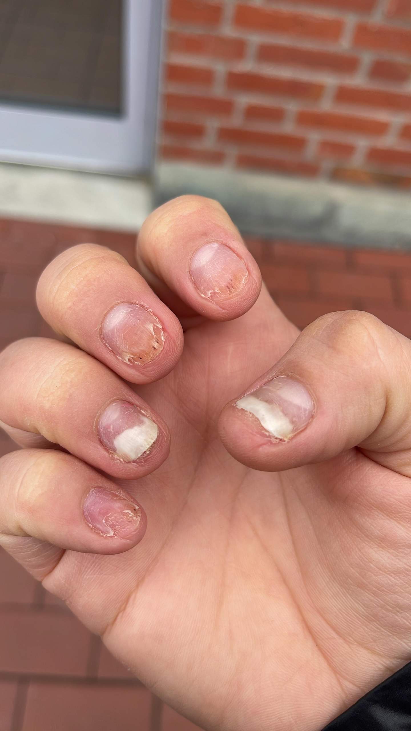 Nagel Löst Sich Vom Nagelbett Shellac Alle Nägel lösen sich vom Nagelbett langsam ab? (Gesundheit und Medizin