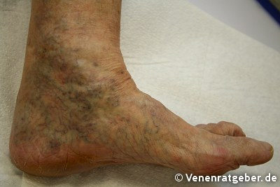 Raucherbeine Was Hab Ich Am Bein Gesundheit K rper Rauchen Raucherbeine Was Hab Ich Am Bein Gesundheit K rper Rauchen