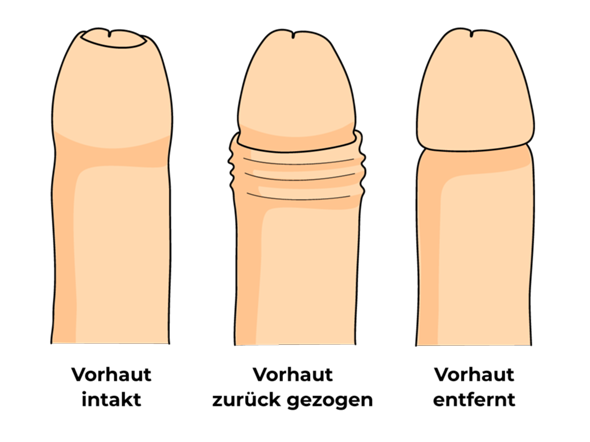 Woran sieht man ob man beschnitten ist? (Jungs, Selbstbefriedigung, Penis) Woran sieht man ob man beschnitten ist? (Jungs, Selbstbefriedigung, Penis)