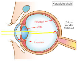 - (Augen, Brille, Kontaktlinsen)