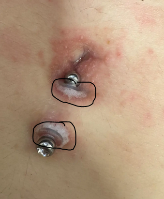 - (Schmerzen, Piercing, Entzündung)