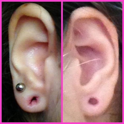 Kleine Rillen Im Gedehnten 6mm Tunnel Ist Es Gerissen Gesundheit