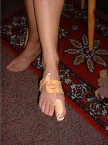 angelegte HV Nachtschiene - (Medizin, Füße, Orthopäde)