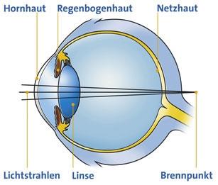 Das zur Weitsichtigkeit - (Physik, Augen, Optik)