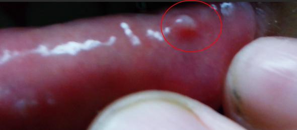 Kleines weißes Bläschen an Unterlippe :s (Gesundheit, Lippe, Zyste)