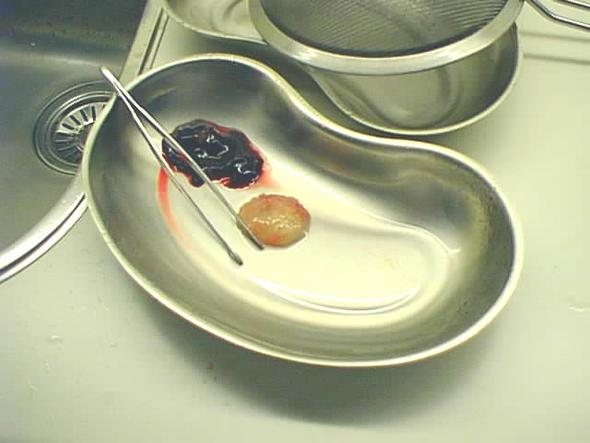 Welche Abtreibungsmethoden Gibt Es Abtreibung Welche Abtreibungsmethoden Gibt Es Abtreibung