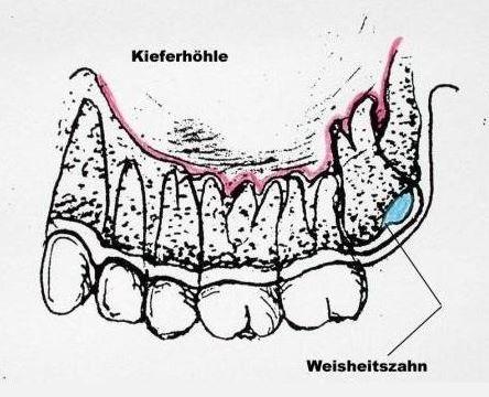 Augenbereich An Tag 3 Nach Weisheitszahn Op Angeschwollen Normal Zahnarzt Weisheitszahne Augenbereich An Tag 3 Nach Weisheitszahn Op Angeschwollen Normal Zahnarzt Weisheitszahne