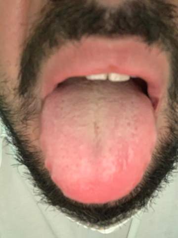 Was Kann Das Sein Soor Oder Eine Belegte Zunge Gesundheit Und Medizin Was Kann Das Sein Soor Oder Eine Belegte Zunge Gesundheit Und Medizin